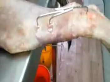 Fijación de fracturas femorales en perros pequeños con tornillos externos para evitar el riesgo de desplazamiento y complicaciones debido al corto tamaño del fémur Fijación de fracturas femorales en perros pequeños con tornillos externos para evitar el riesgo de desplazamiento y complicaciones debido al corto tamaño del fémur.